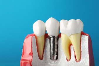 Tired of High Dental Bills? Discover Low-Cost Options for Dental Implants!