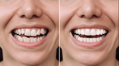 Can You Fix Crooked Teeth Without Braces? (Alternative Treatments)