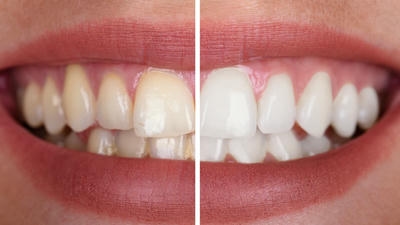 Teeth Whitening: Professional vs. At-Home Treatments Compared